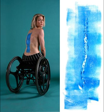 woman in wheelchair with scar
